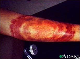 Lyme Disease Rash Image